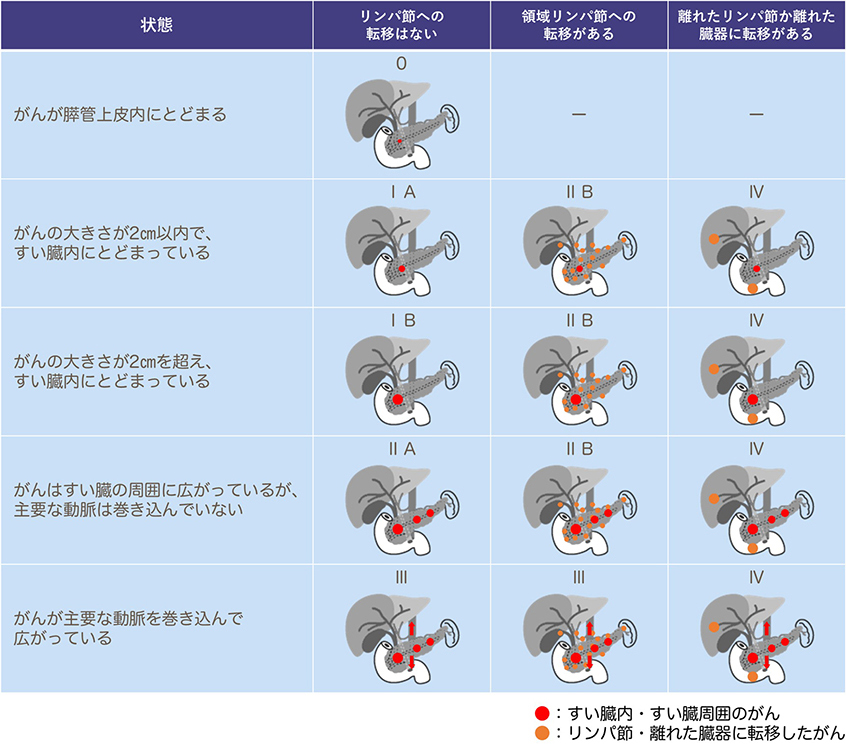 すい臓がんのステージ